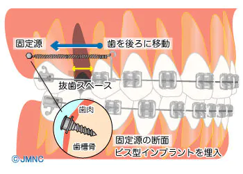 取り扱っている矯正装置の種類⑤