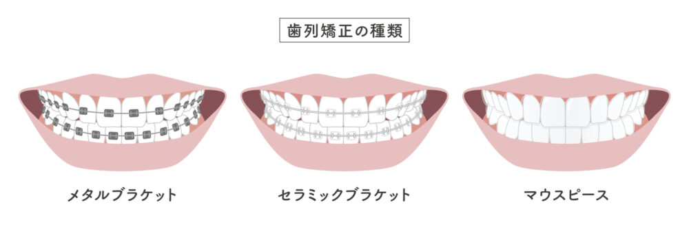 患者様の歯並び・かみ合わせに合わせたオーダーメイドの矯正歯科治療【矯正装置が豊富】